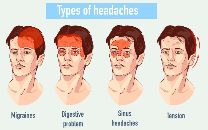 Types Of Headaches Chart Image 8886