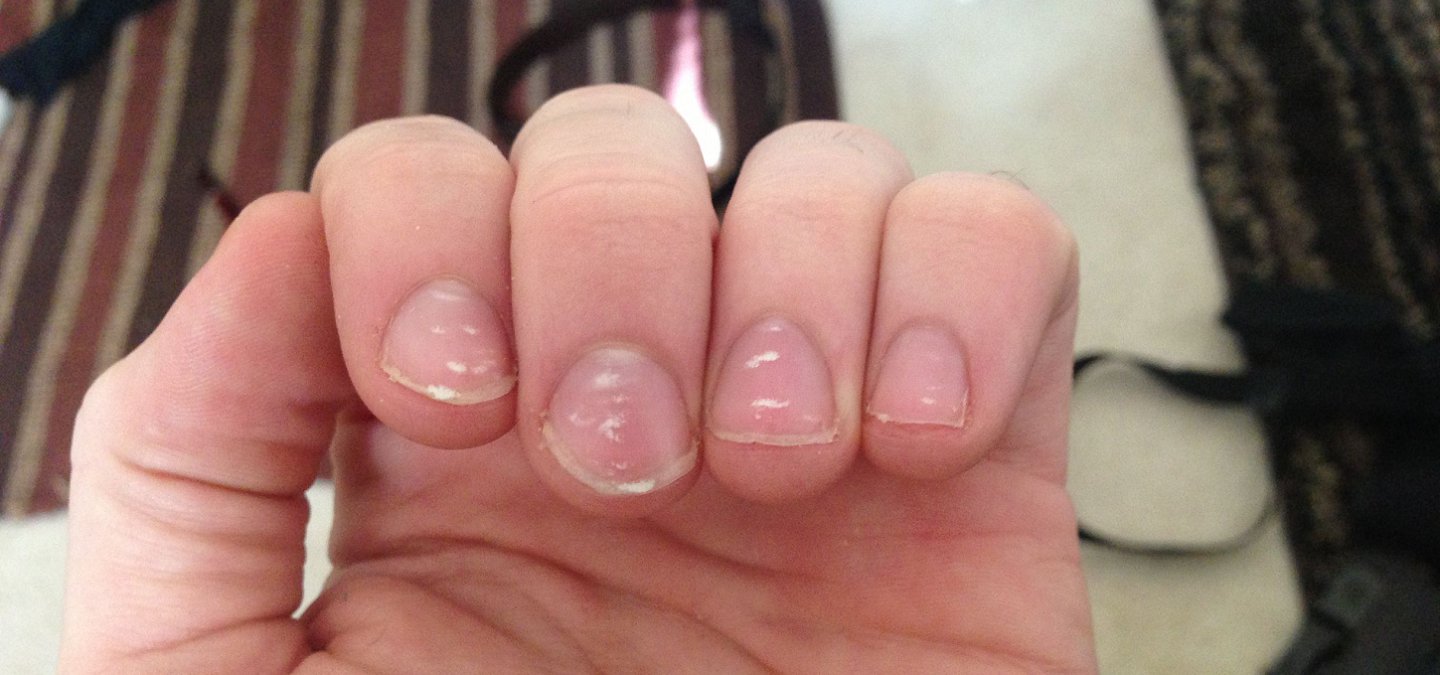 Causes Of Black Marks On Nails