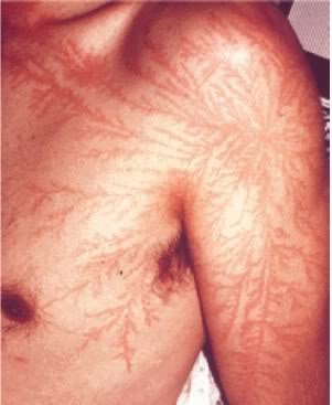 lightning scars black person