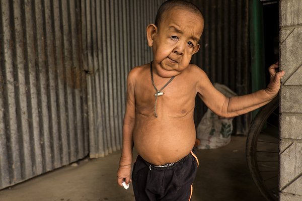 Baby With Rare Genetic Disorder Born In Bangladesh. He Will Age 8 Times ...