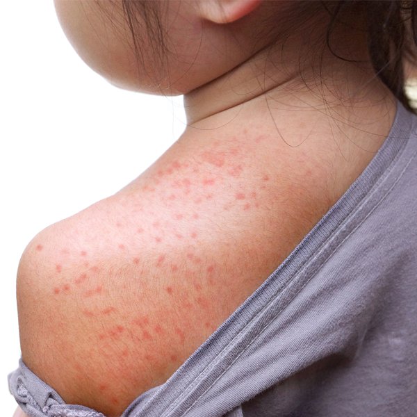 13-best-rashes-images-on-pinterest-itchy-rash-med-school-and-medical