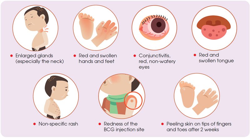 Delhi Hospitals Report Children With Symptoms Similar To A Rare Illness Called Kawasaki Disease 1